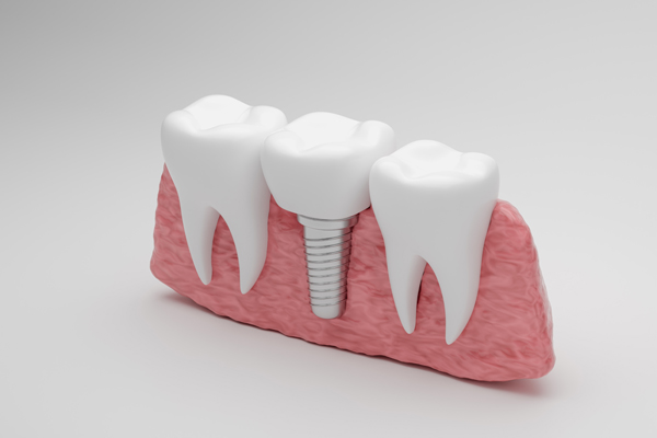 Tooth Replacement    : The Long Term Health Benefits Of Dental Implants